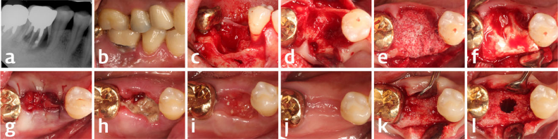 Lee_et_al 2018 Clinical Implant Dentistry and Related Research